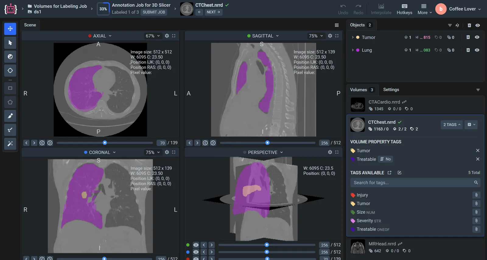 The Supervisely DICOM toolbox with a lung and a tumor segmented as 3D masks in the axial, sagittal, coronal and 3D views of a chest CT