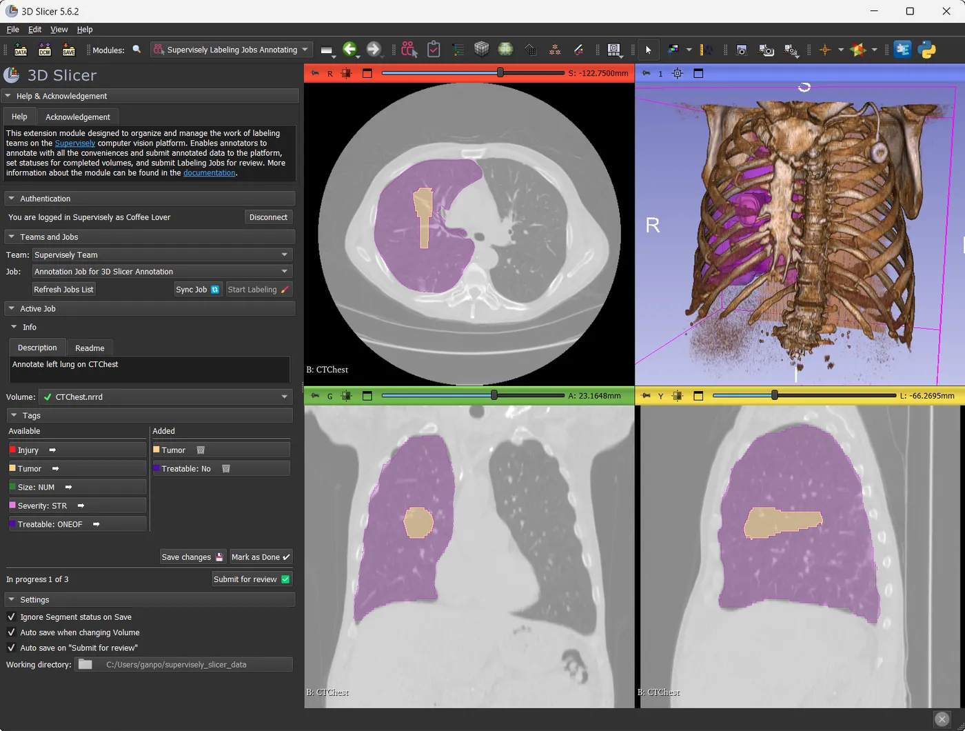 3D Slicer with the Supervisely Labeling Jobs Annotating module: the team, the labeling job, the volume, its tags and the Submit for review button next to a chest CT with a lung and a tumor segmented